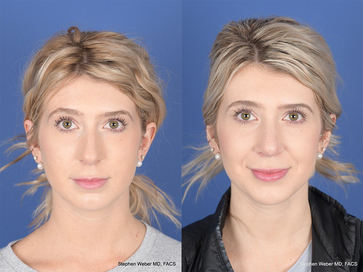 Rhinoplasty Before & After Gallery - Patient 303325 - Image 1