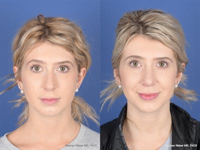 Rhinoplasty Before & After Gallery - Patient 303325 - Image 1
