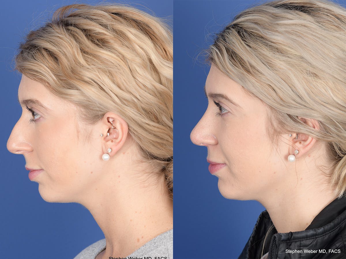 Rhinoplasty Before & After Gallery - Patient 303325 - Image 2