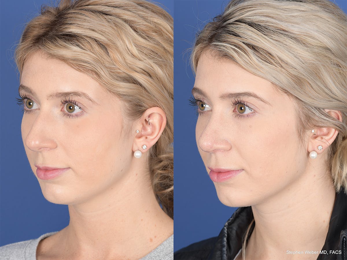 Rhinoplasty Before & After Gallery - Patient 303325 - Image 3