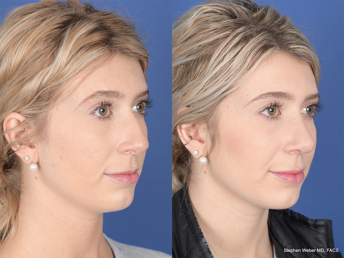 Rhinoplasty Before & After Gallery - Patient 303325 - Image 4