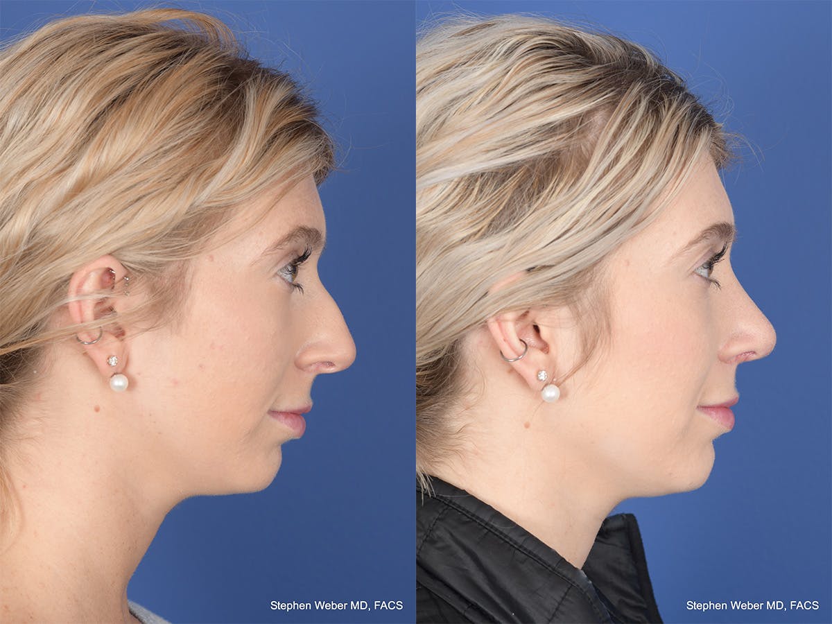 Rhinoplasty Before & After Gallery - Patient 303325 - Image 5