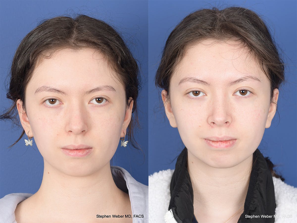 Rhinoplasty Before & After Gallery - Patient 214575 - Image 1