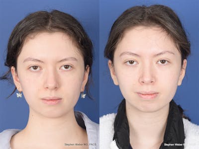 Rhinoplasty Before & After Gallery - Patient 214575 - Image 1