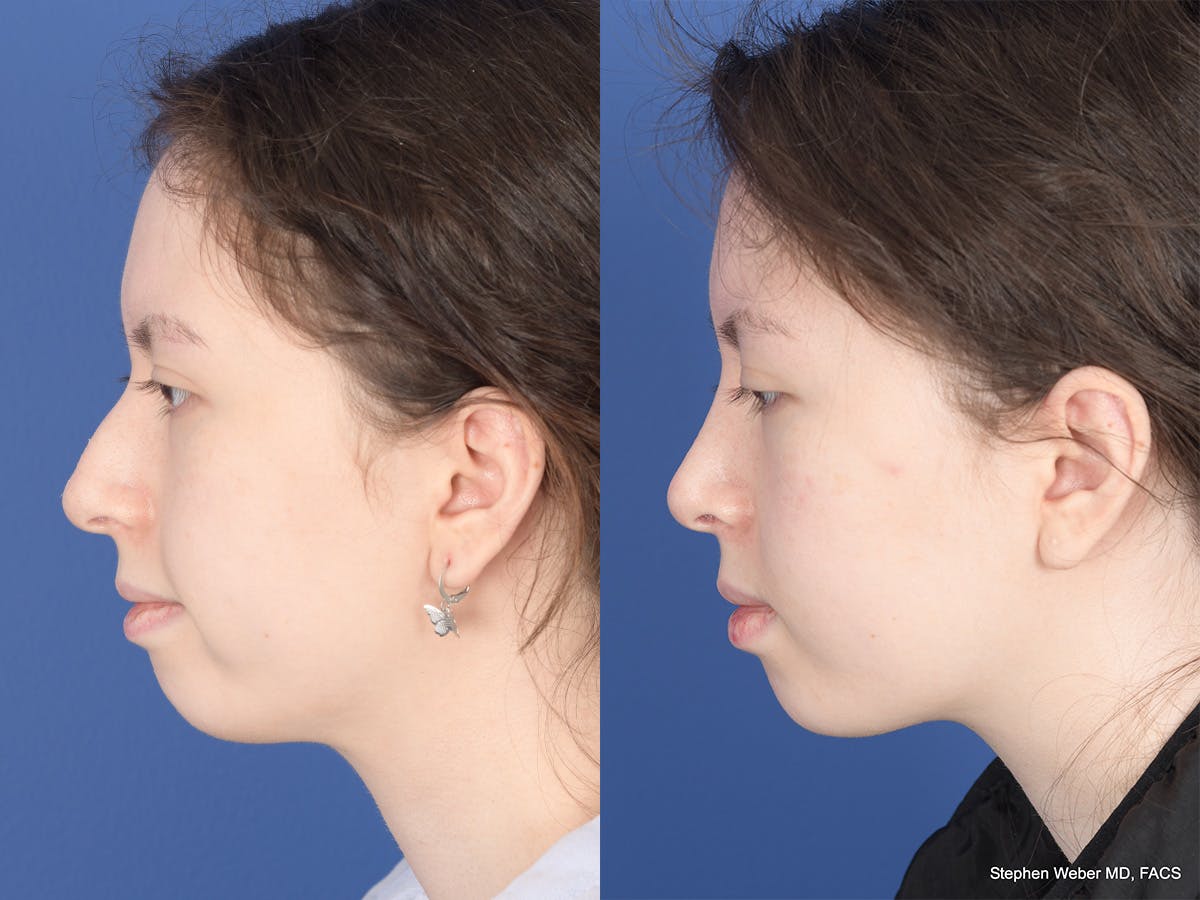 Rhinoplasty Before & After Gallery - Patient 214575 - Image 2