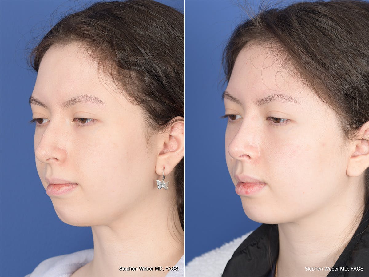 Rhinoplasty Before & After Gallery - Patient 214575 - Image 3
