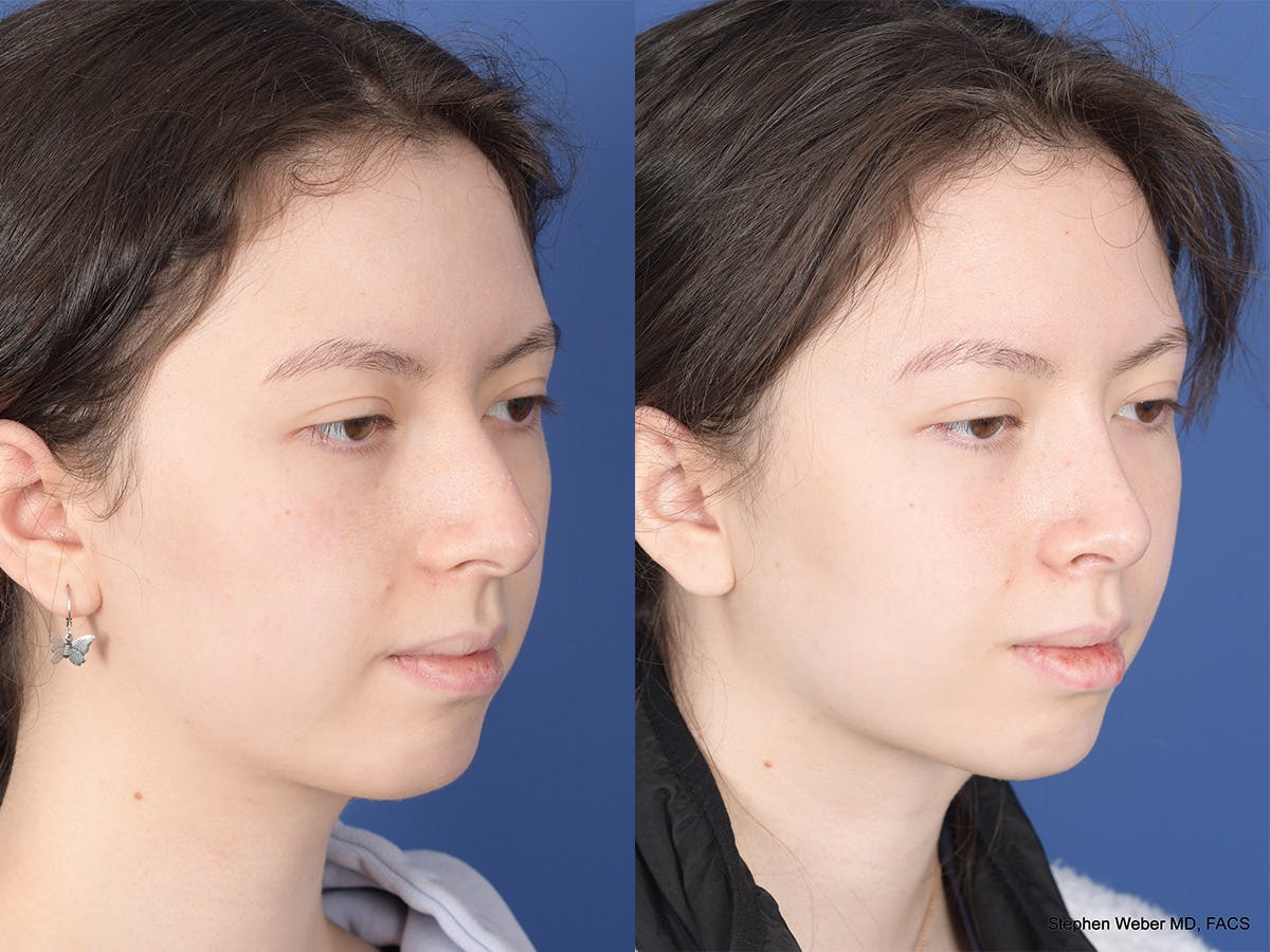 Rhinoplasty Before & After Gallery - Patient 214575 - Image 4