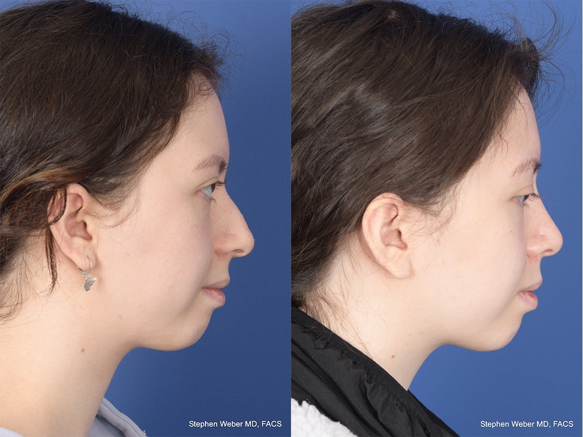 Rhinoplasty Before & After Gallery - Patient 214575 - Image 5