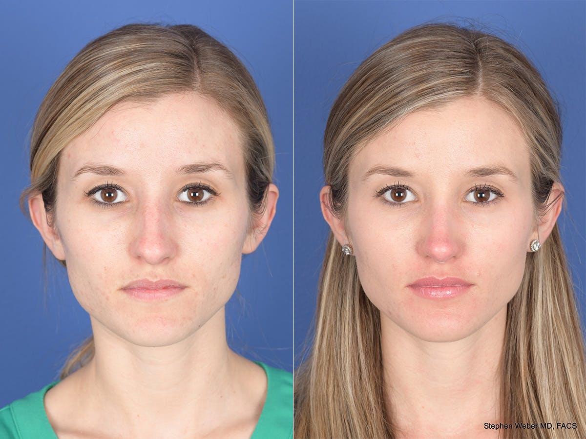 Rhinoplasty Before & After Gallery - Patient 417210 - Image 1