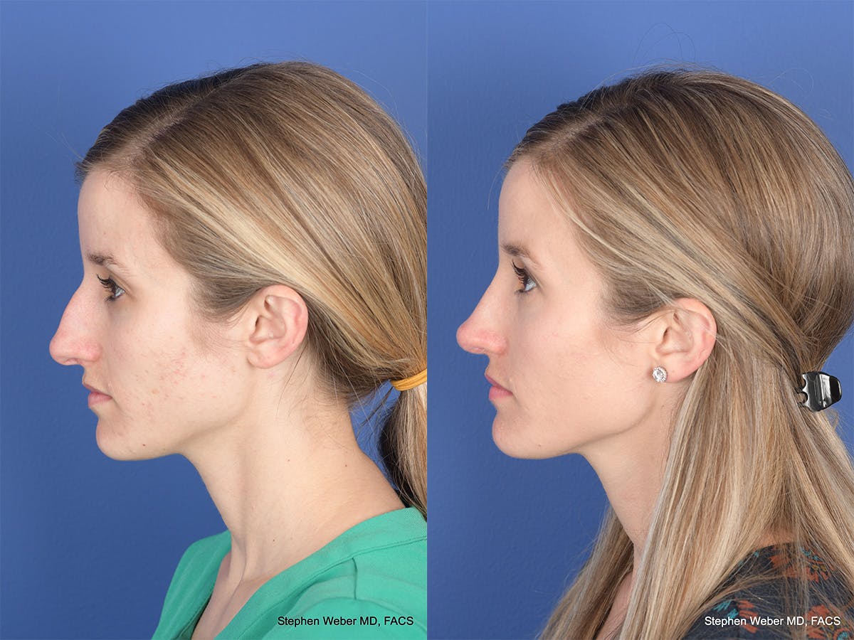 Rhinoplasty Before & After Gallery - Patient 417210 - Image 2