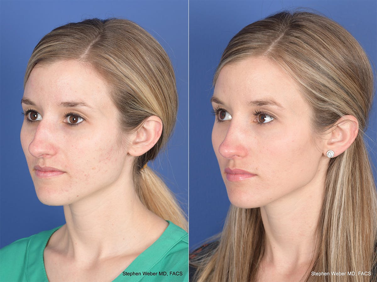 Rhinoplasty Before & After Gallery - Patient 417210 - Image 3