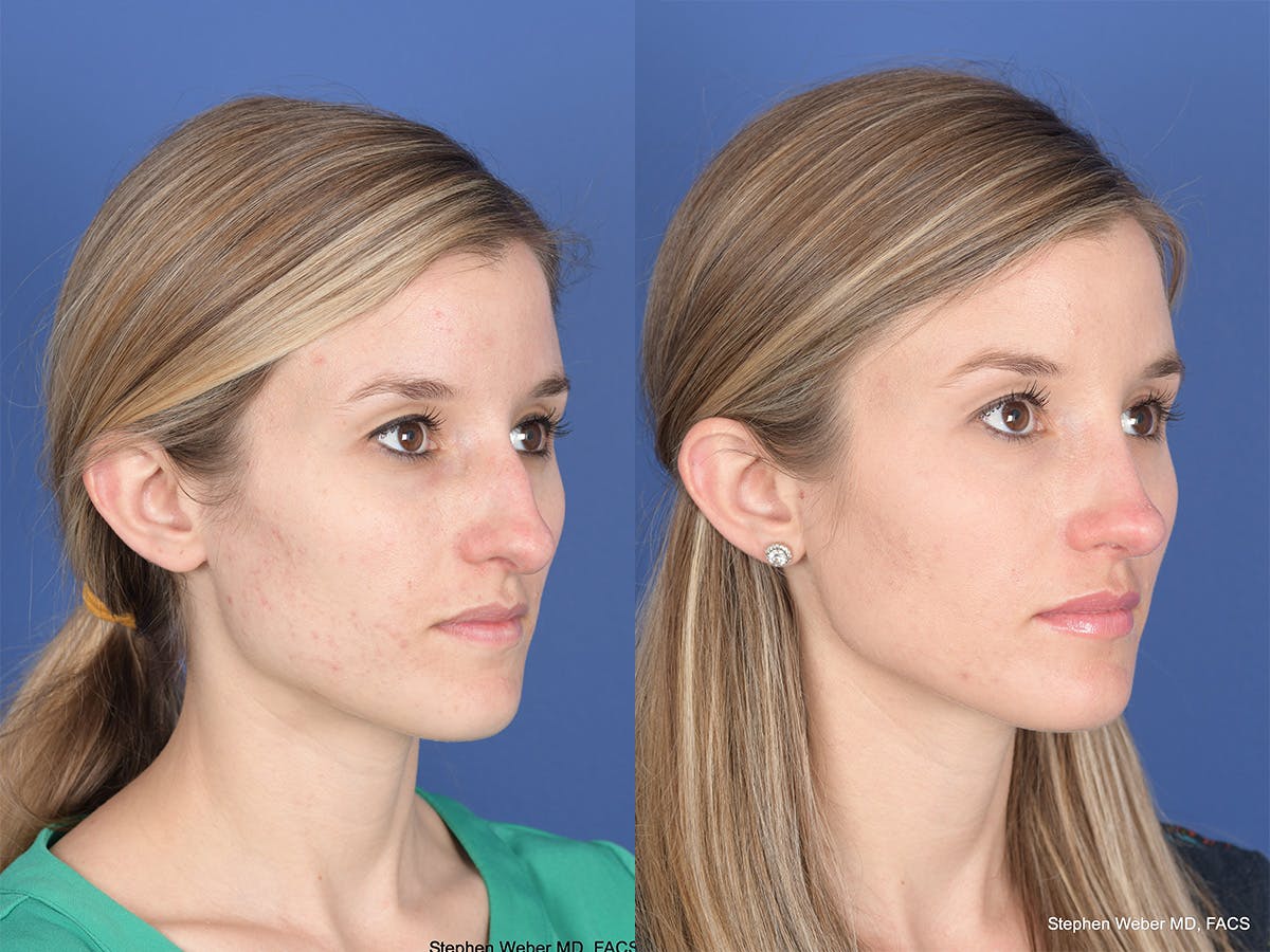 Rhinoplasty Before & After Gallery - Patient 417210 - Image 4