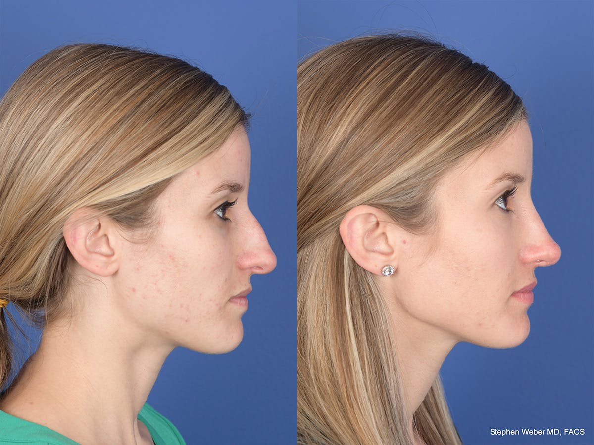 Rhinoplasty Before & After Gallery - Patient 417210 - Image 5