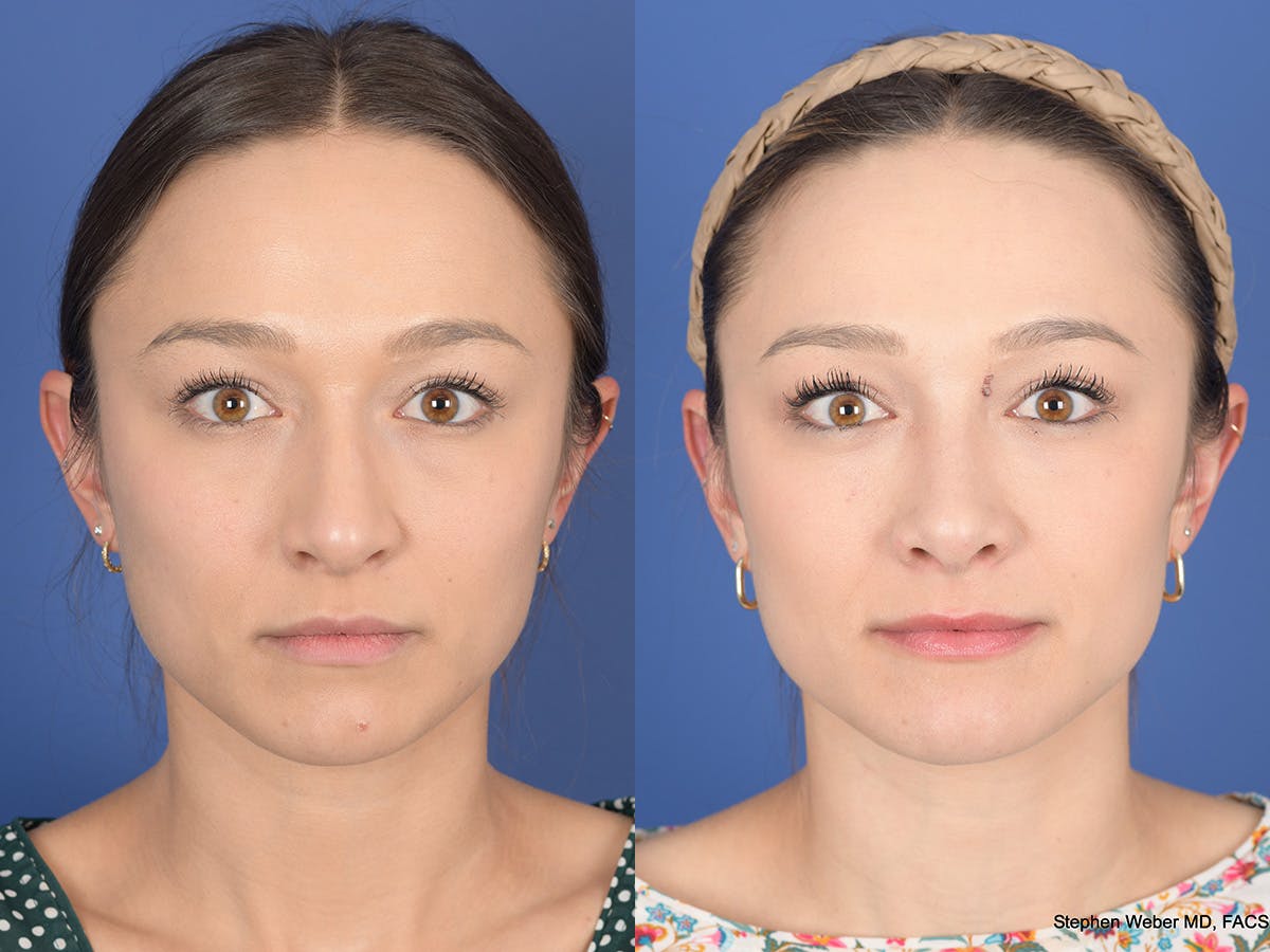 Rhinoplasty Before & After Gallery - Patient 249828 - Image 1