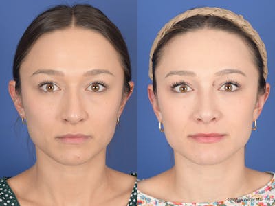 Rhinoplasty Before & After Gallery - Patient 249828 - Image 1