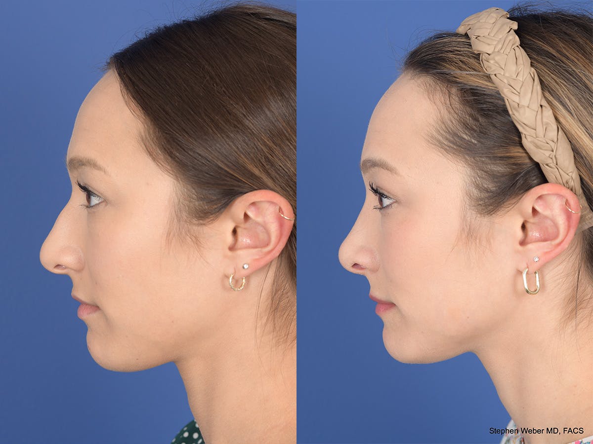 Rhinoplasty Before & After Gallery - Patient 249828 - Image 2