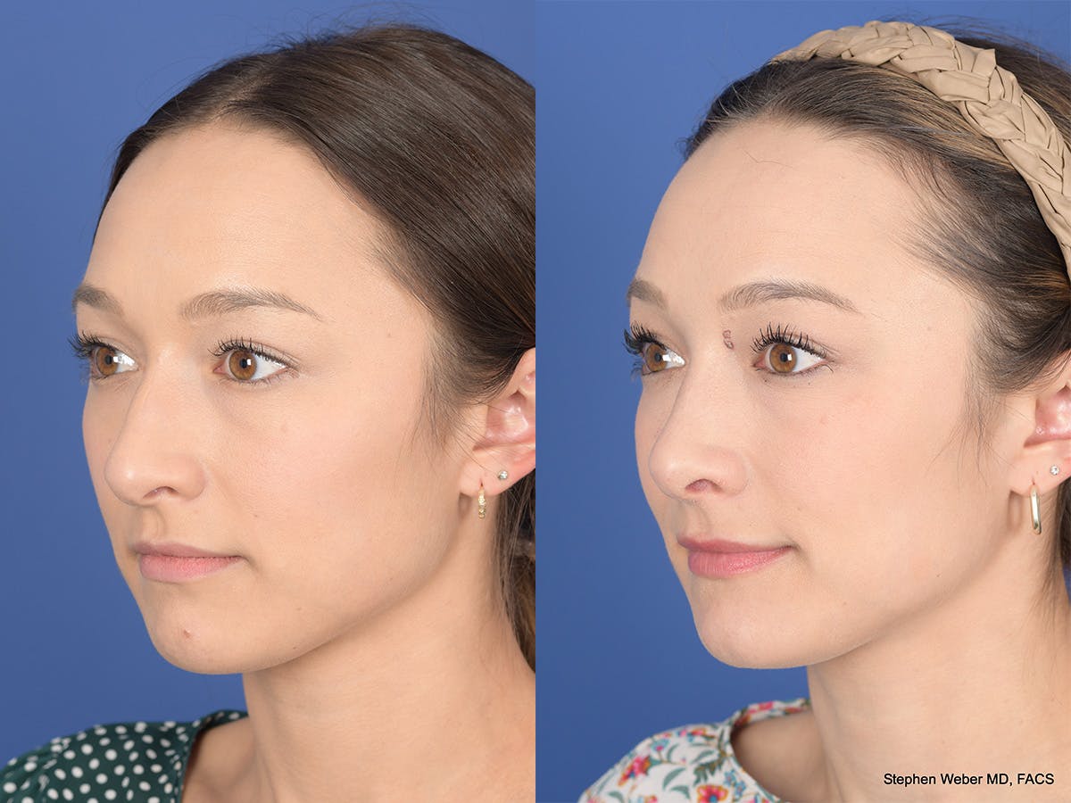Rhinoplasty Before & After Gallery - Patient 249828 - Image 3