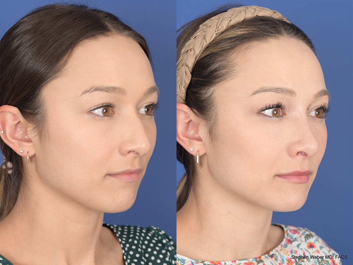 Rhinoplasty Before & After Gallery - Patient 249828 - Image 4