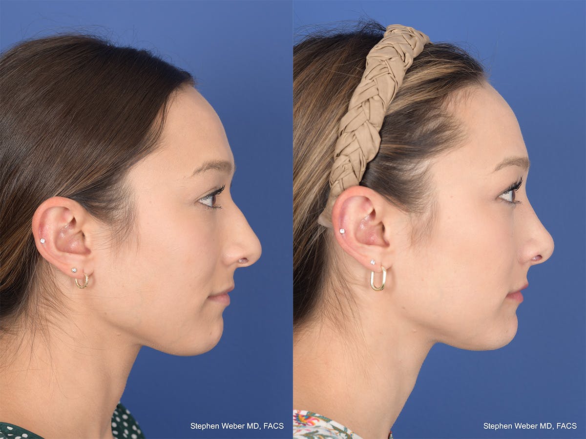 Rhinoplasty Before & After Gallery - Patient 249828 - Image 5