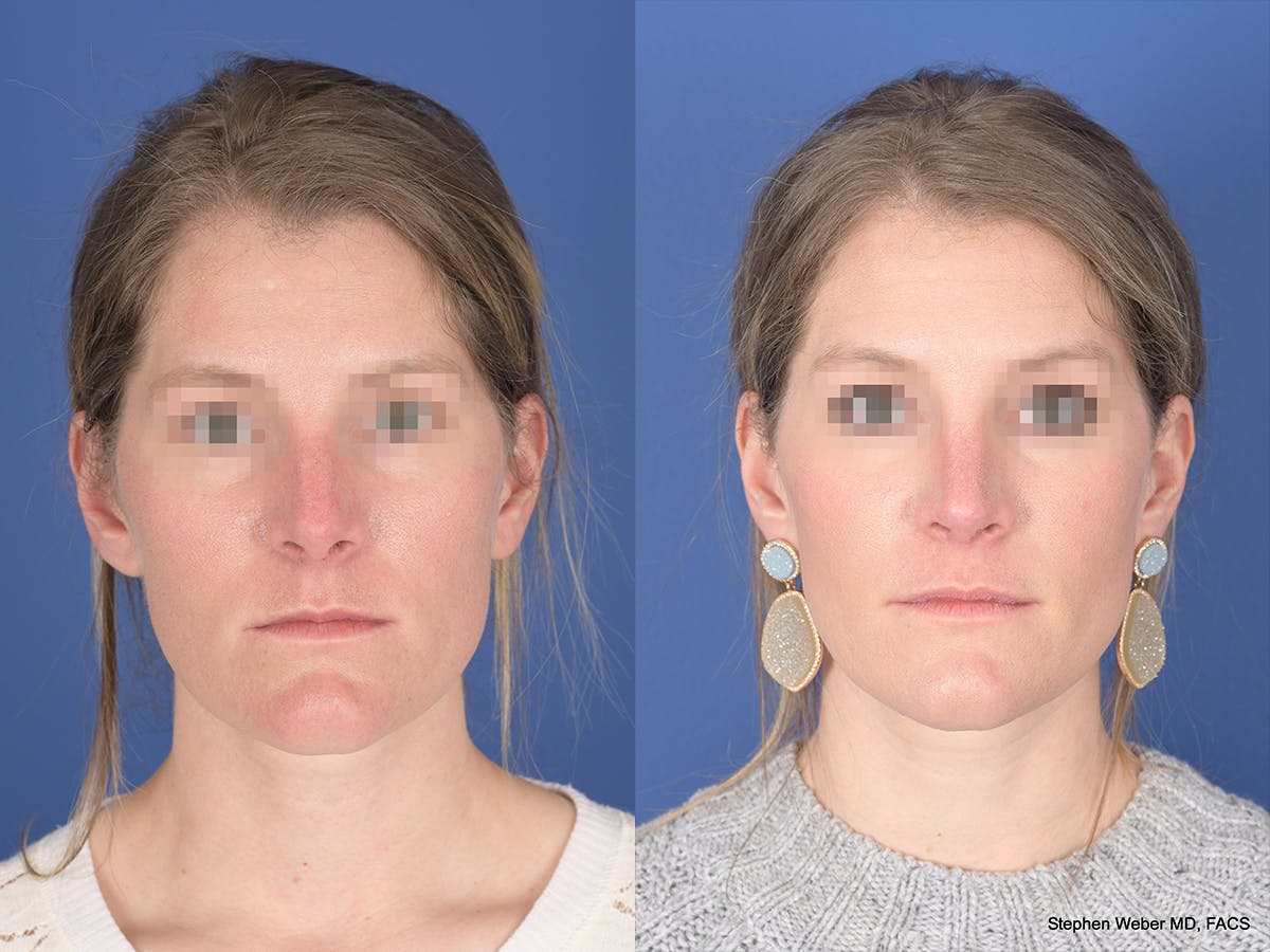 Rhinoplasty Before & After Gallery - Patient 158436 - Image 1