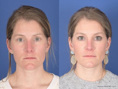 Rhinoplasty Before & After Gallery - Patient 158436 - Image 1