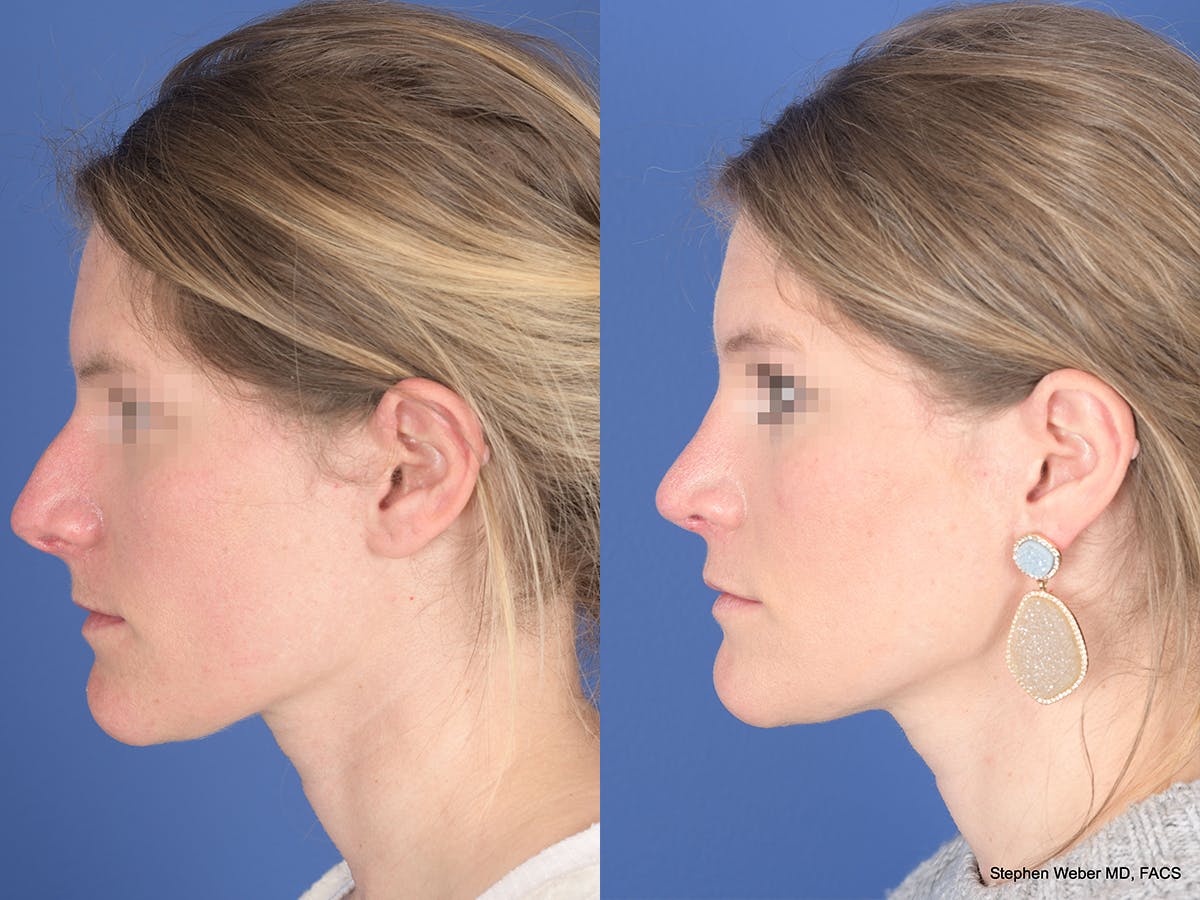 Rhinoplasty Before & After Gallery - Patient 158436 - Image 2