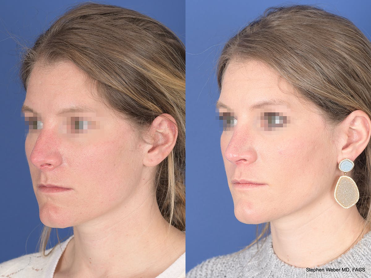 Rhinoplasty Before & After Gallery - Patient 158436 - Image 3
