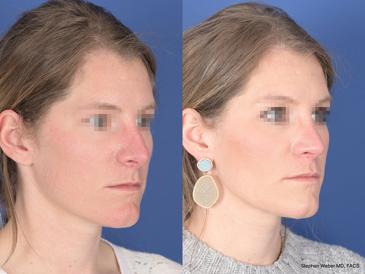 Rhinoplasty Before & After Gallery - Patient 158436 - Image 4