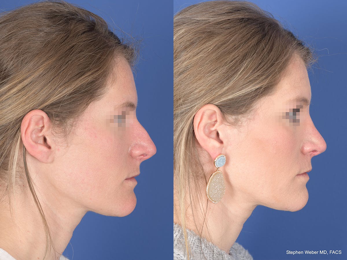 Rhinoplasty Before & After Gallery - Patient 158436 - Image 5