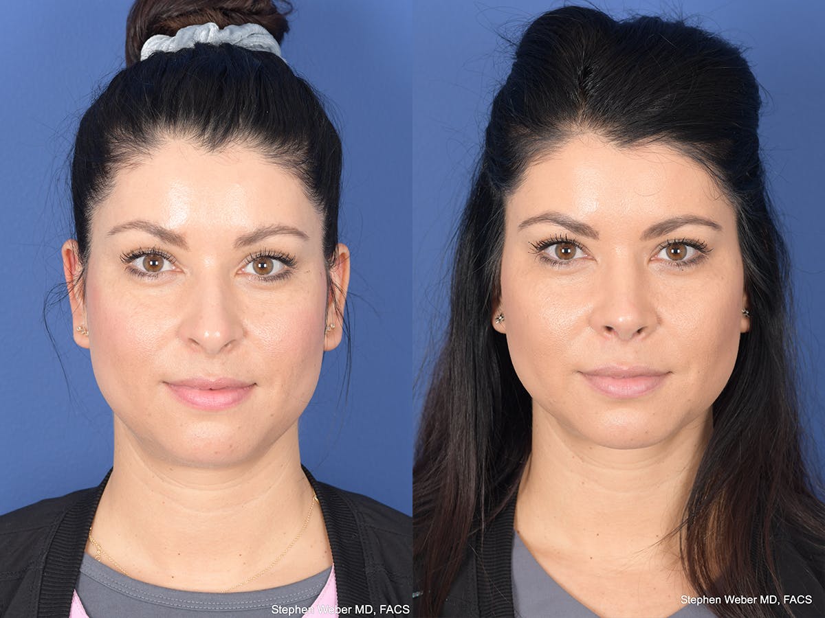 Rhinoplasty Before & After Gallery - Patient 308231 - Image 1