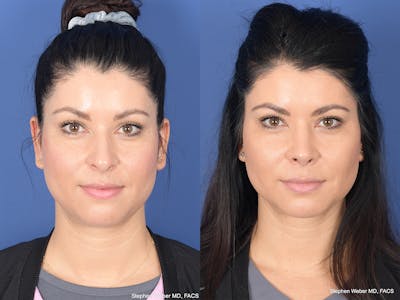Rhinoplasty Before & After Gallery - Patient 308231 - Image 1