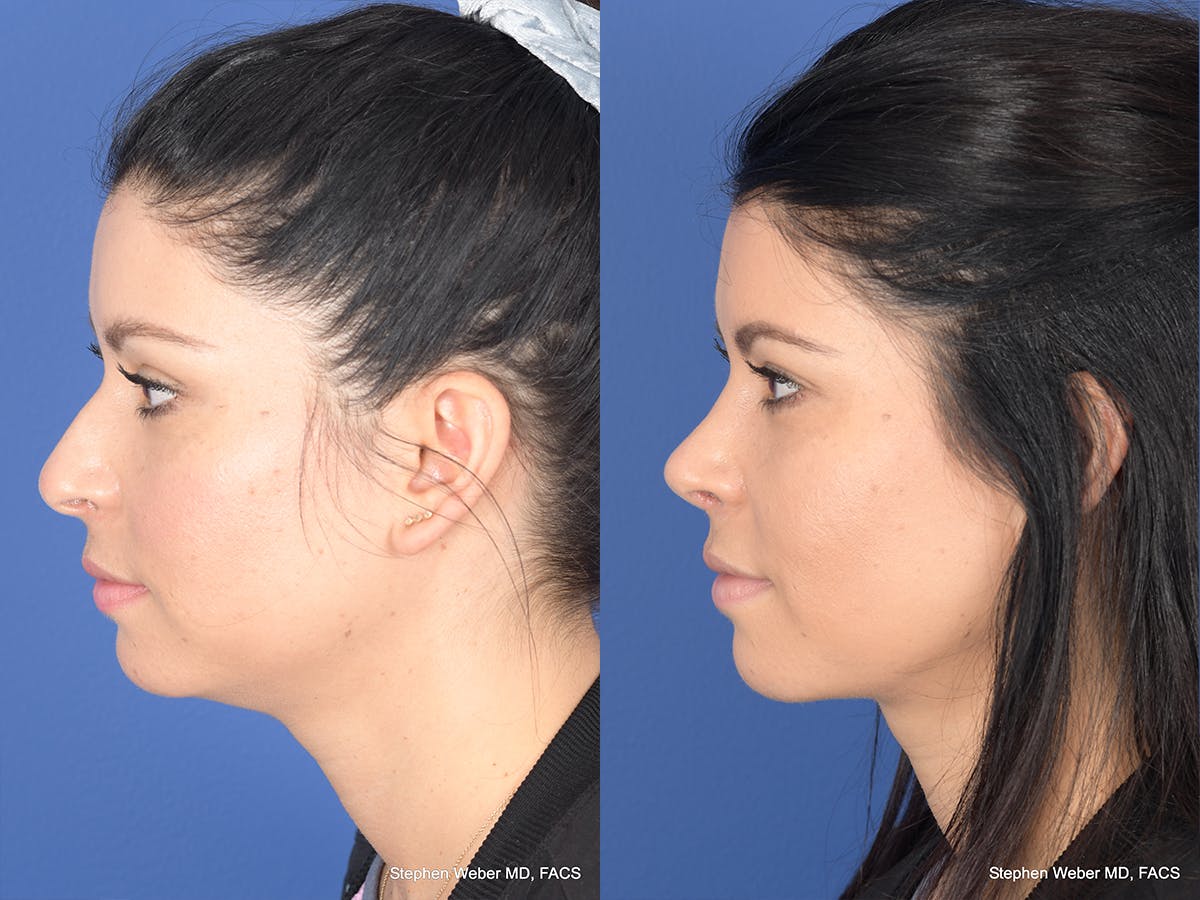 Rhinoplasty Before & After Gallery - Patient 308231 - Image 2