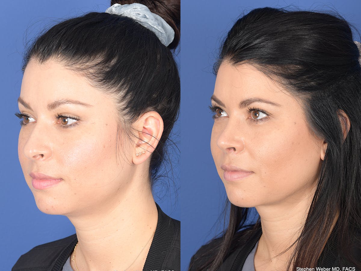 Rhinoplasty Before & After Gallery - Patient 308231 - Image 3