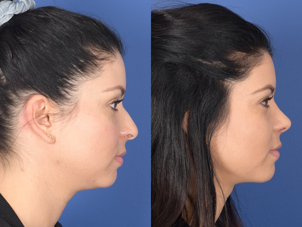 Rhinoplasty Before & After Gallery - Patient 308231 - Image 5