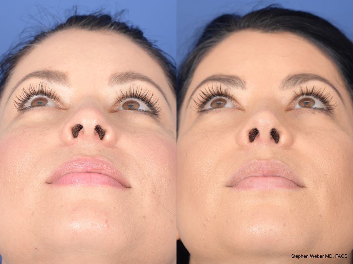 Rhinoplasty Before & After Gallery - Patient 308231 - Image 6