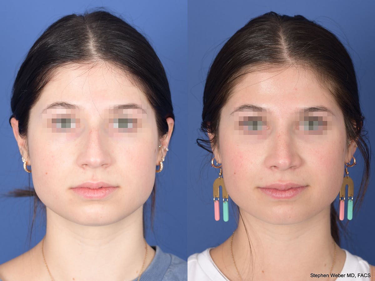 Rhinoplasty Before & After Gallery - Patient 127488 - Image 1