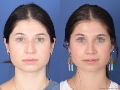 Rhinoplasty Before & After Gallery - Patient 127488 - Image 1