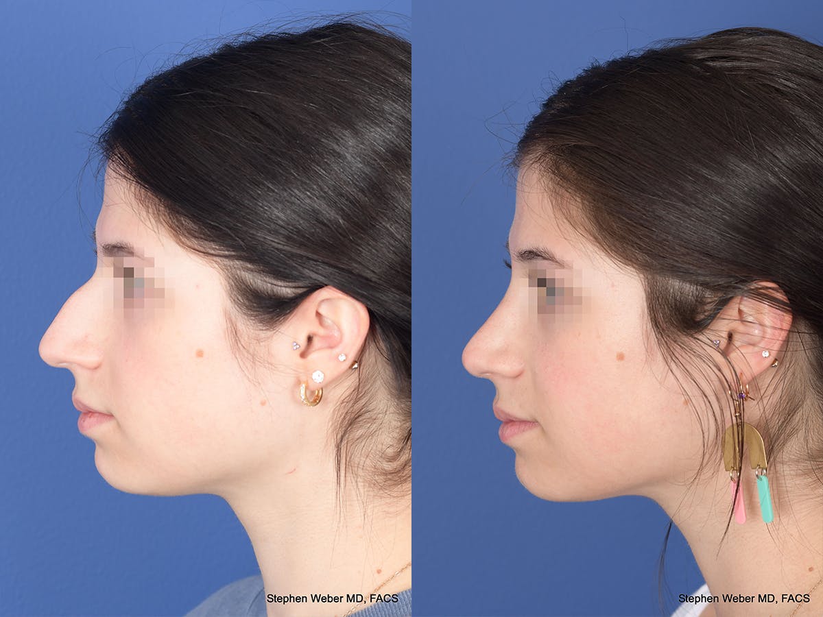 Rhinoplasty Before & After Gallery - Patient 127488 - Image 2