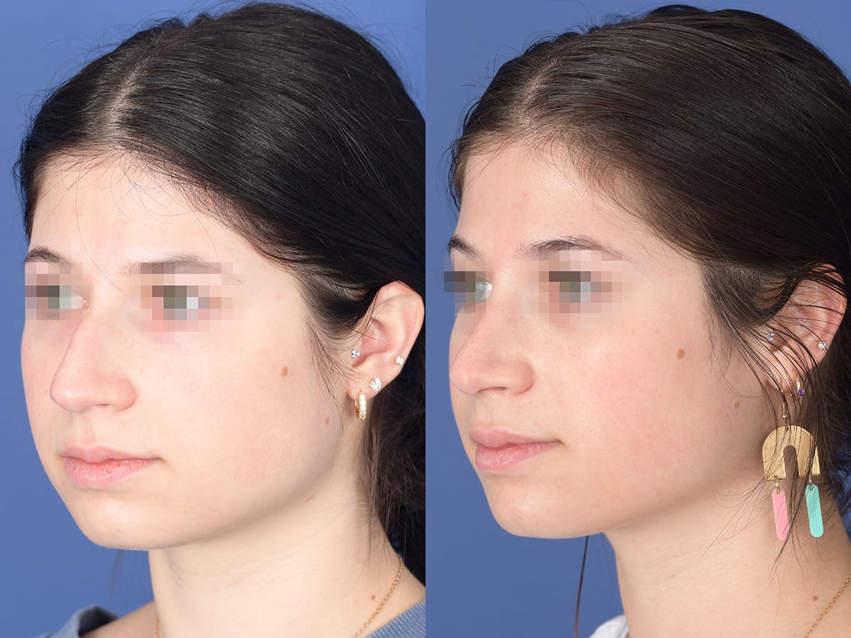 Rhinoplasty Before & After Gallery - Patient 127488 - Image 3