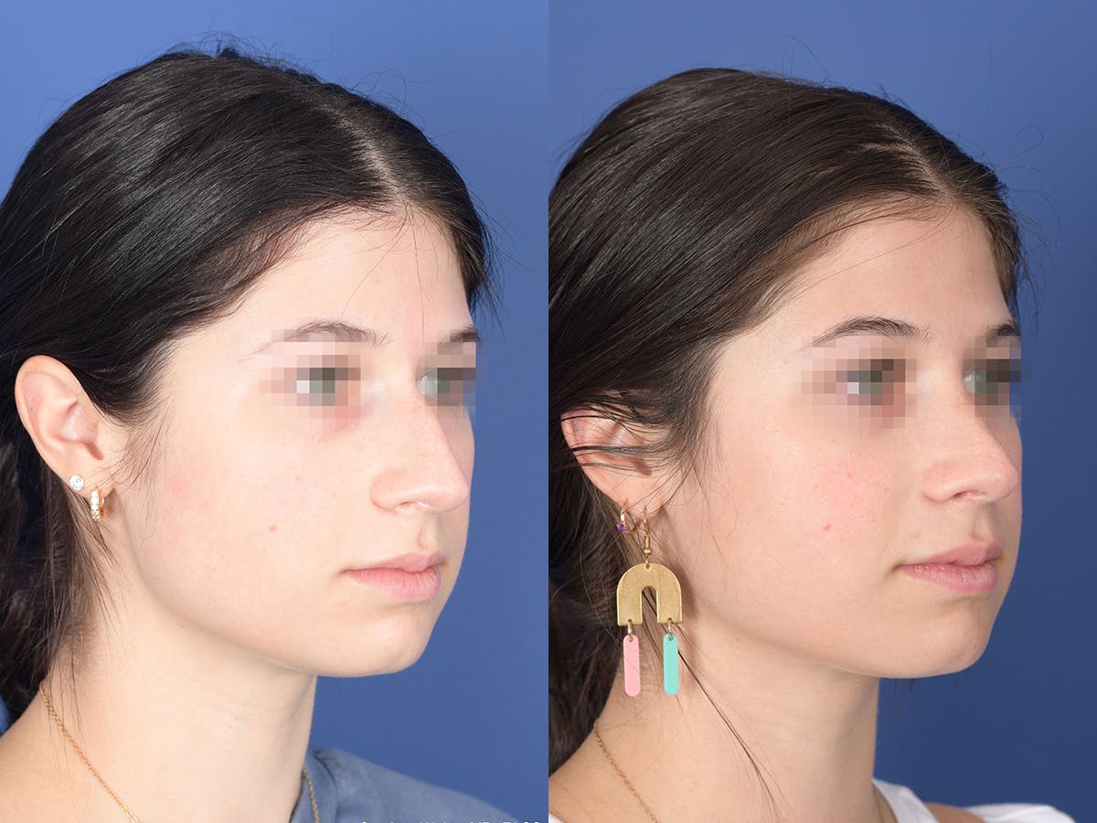 Rhinoplasty Before & After Gallery - Patient 127488 - Image 4