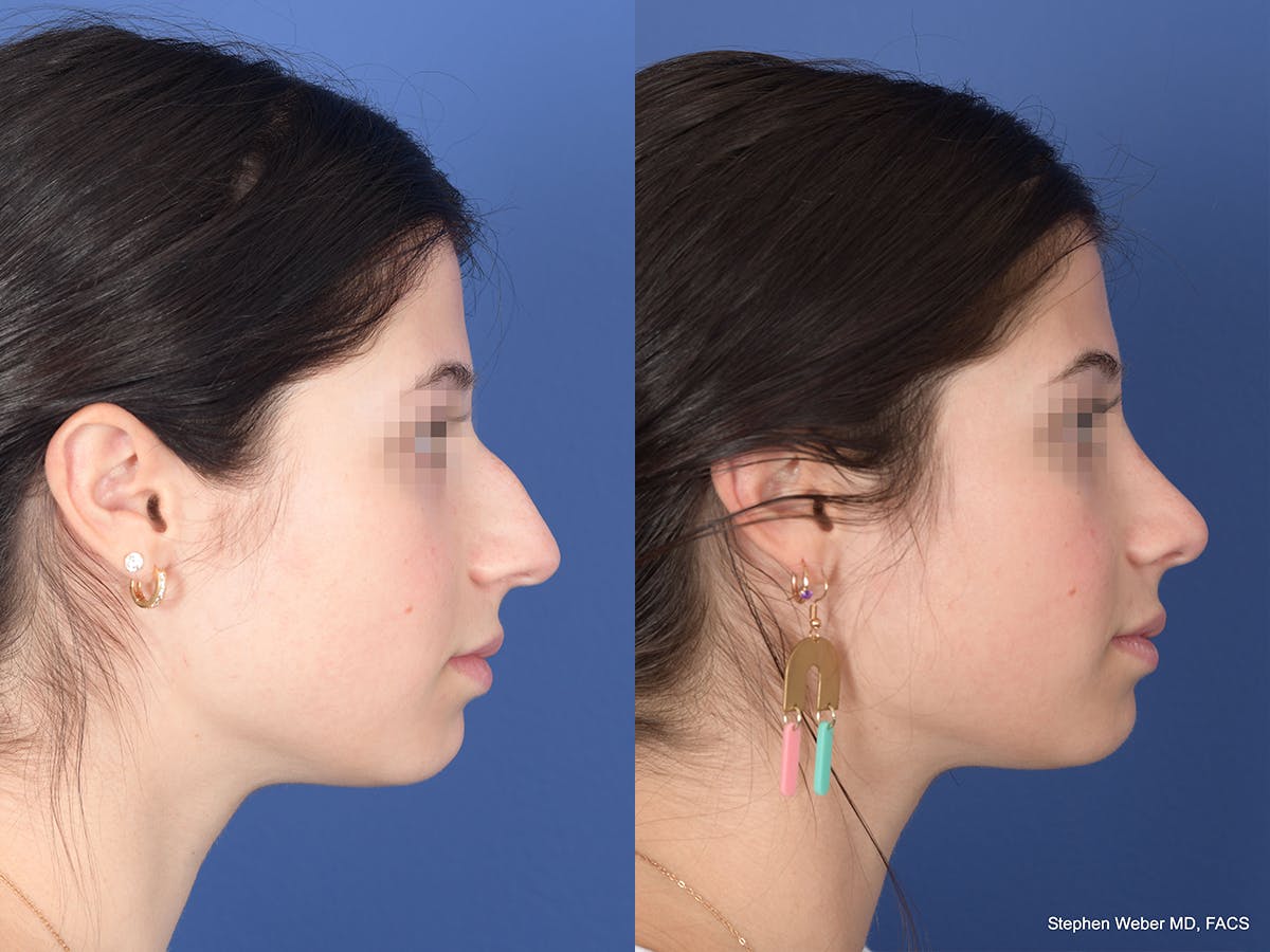 Rhinoplasty Before & After Gallery - Patient 127488 - Image 5