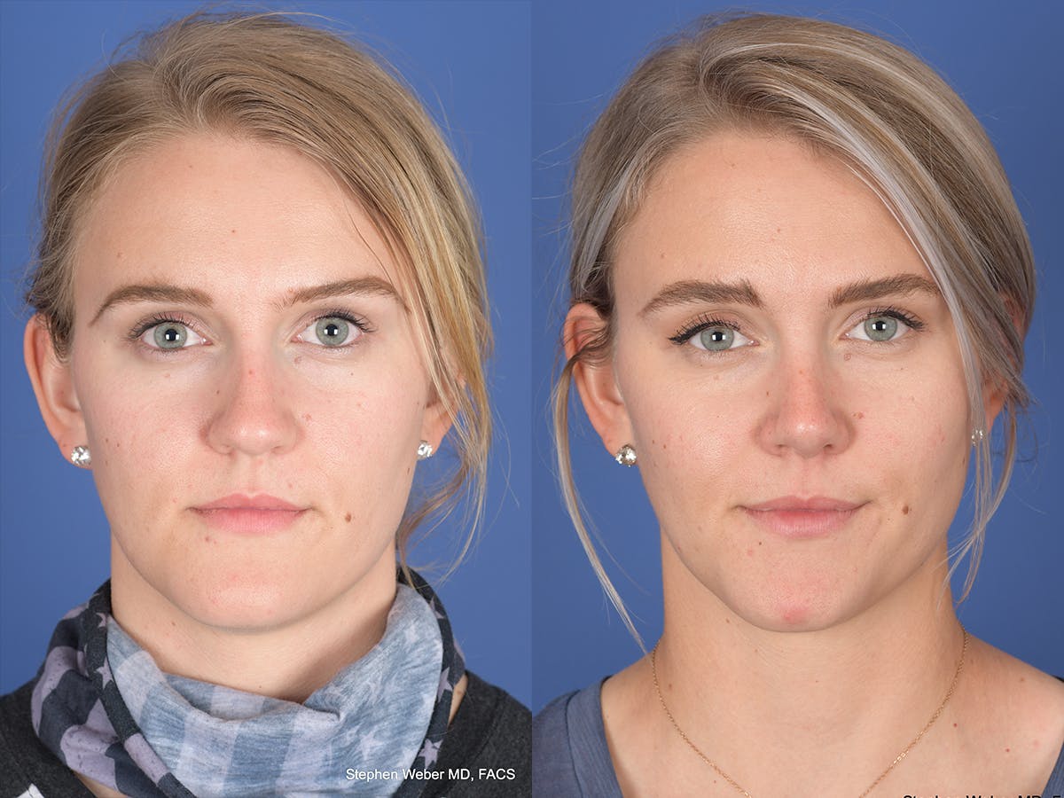 Rhinoplasty Before & After Gallery - Patient 380452 - Image 1