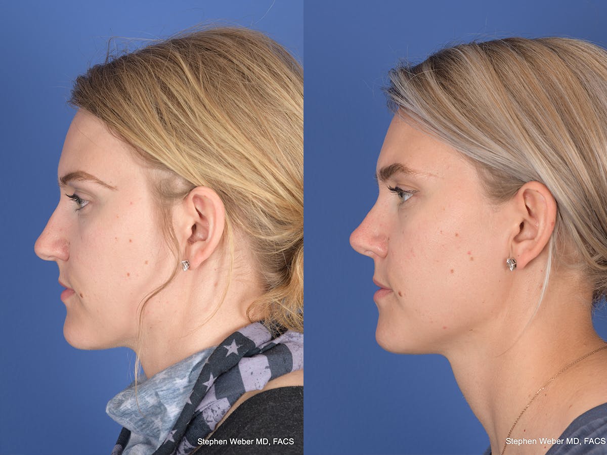 Rhinoplasty Before & After Gallery - Patient 380452 - Image 2