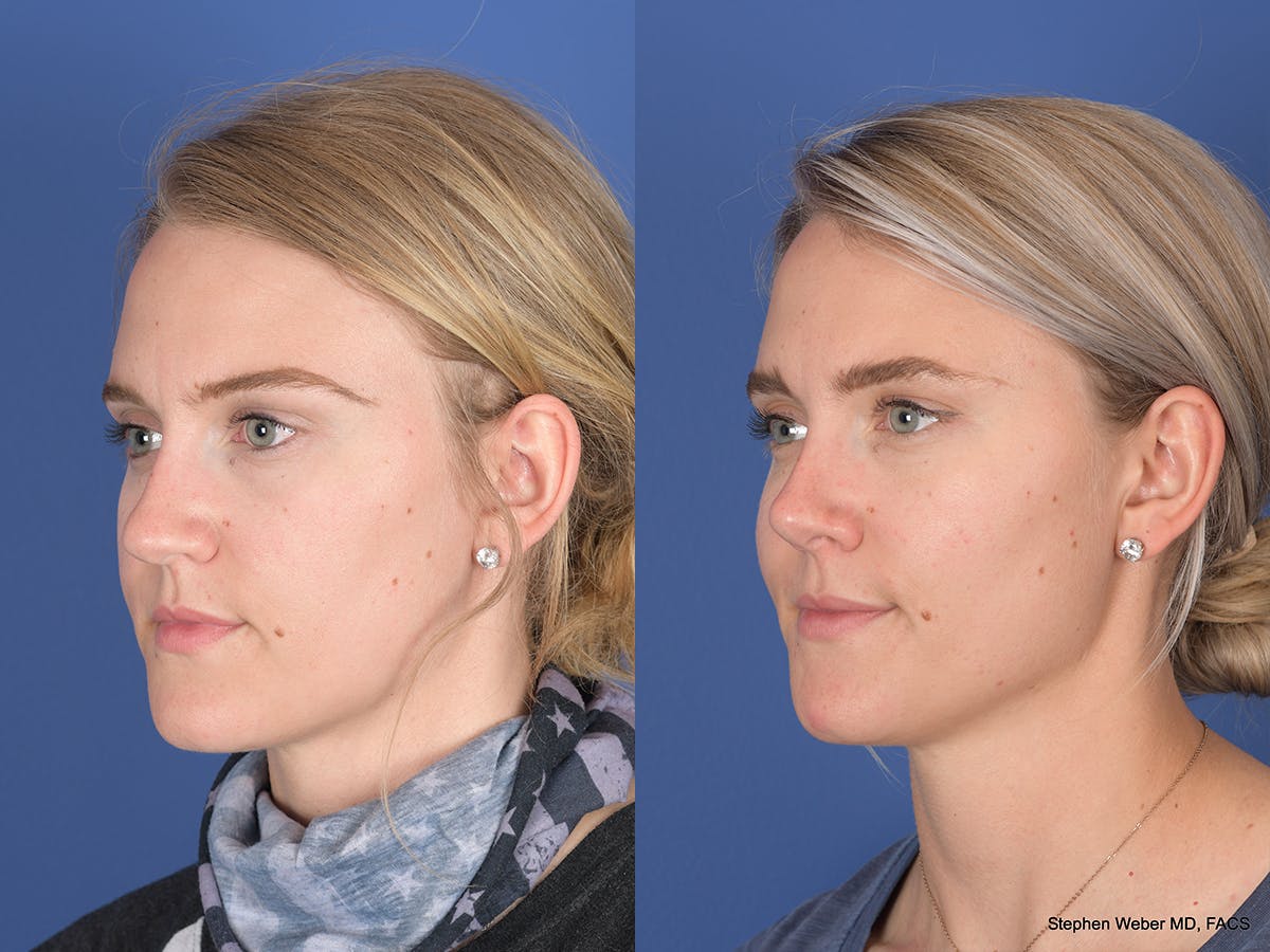 Rhinoplasty Before & After Gallery - Patient 380452 - Image 3