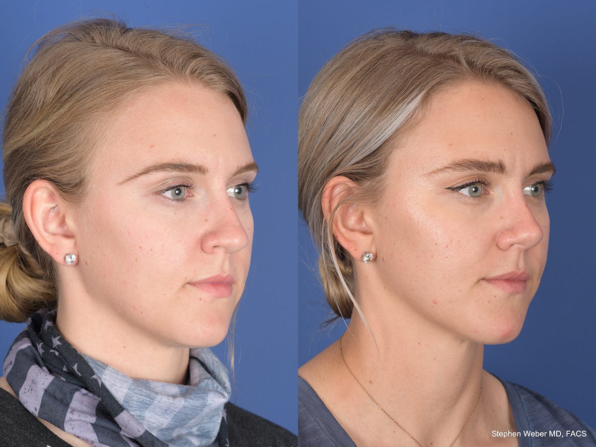 Rhinoplasty Before & After Gallery - Patient 380452 - Image 4