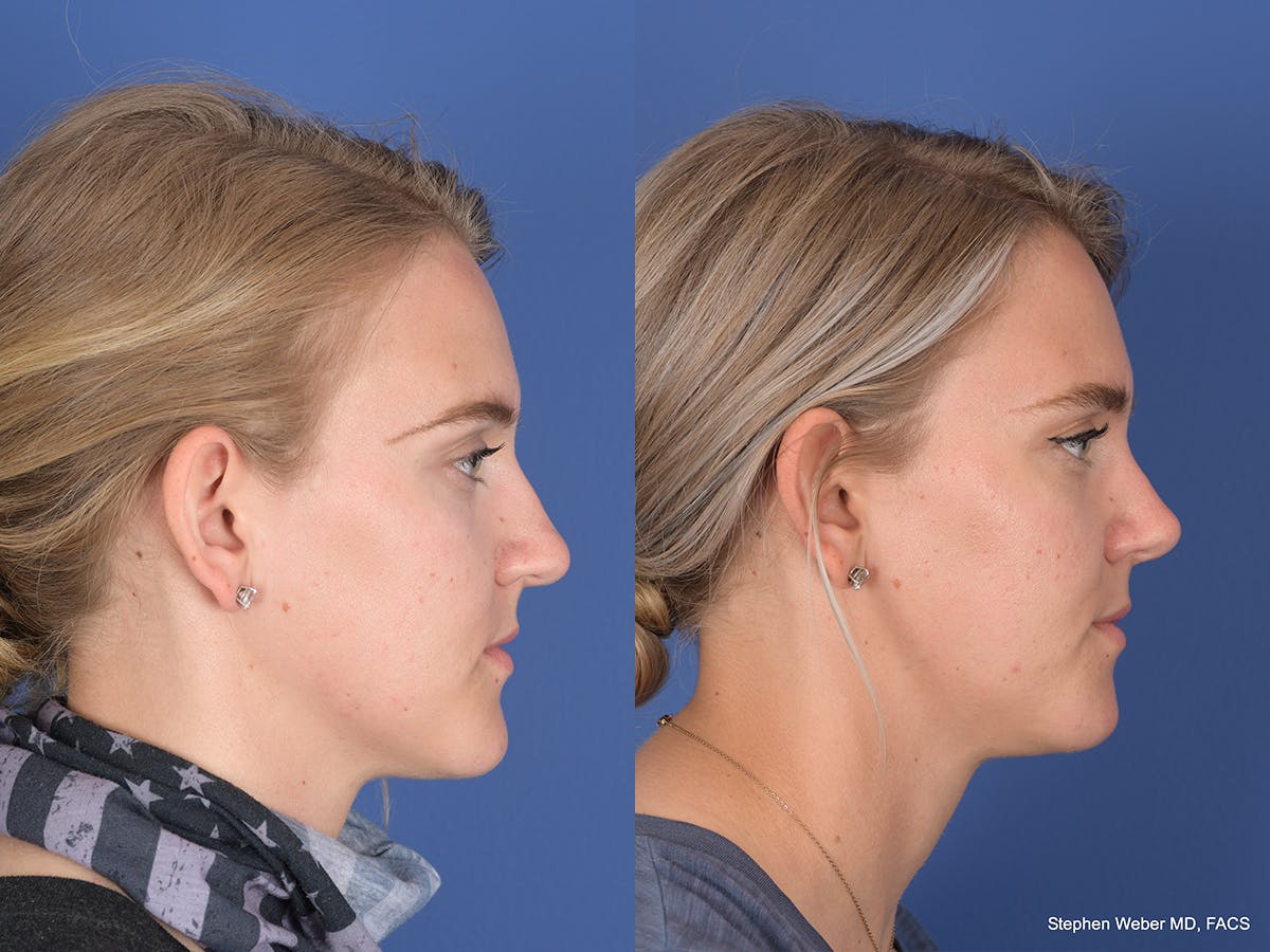 Rhinoplasty Before & After Gallery - Patient 380452 - Image 5