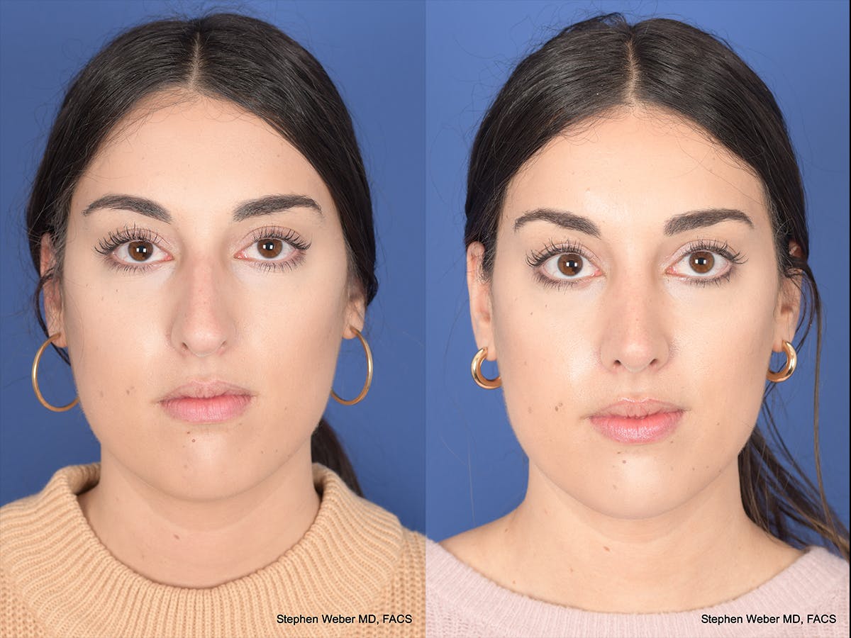 Rhinoplasty Before & After Gallery - Patient 961971 - Image 1