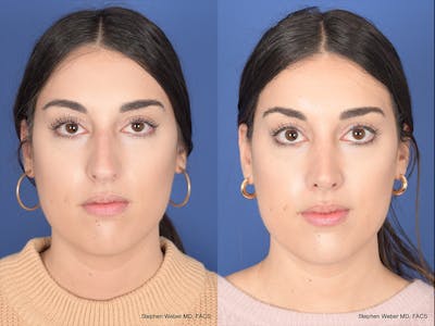 Rhinoplasty Before & After Gallery - Patient 961971 - Image 1