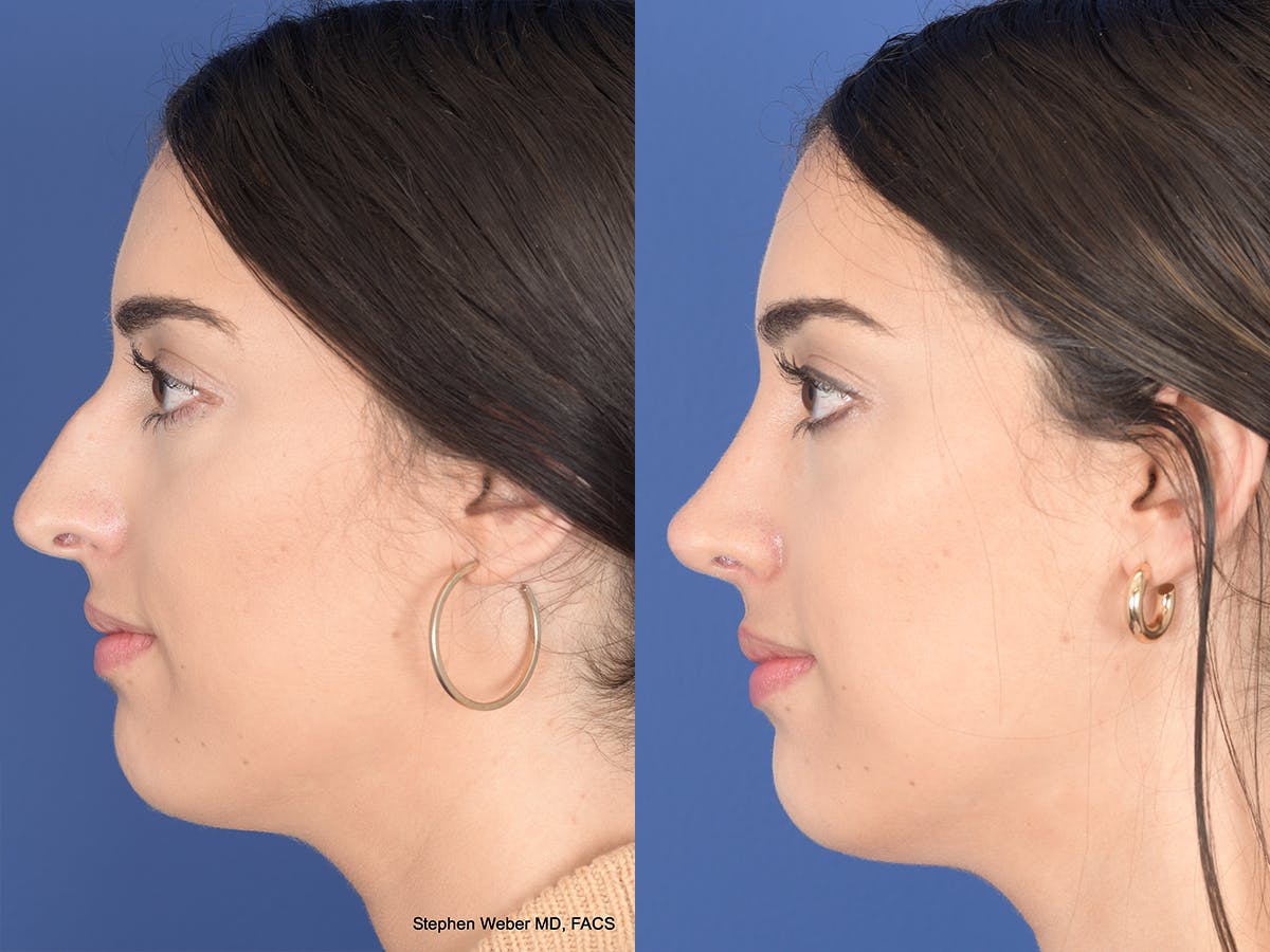 Rhinoplasty Before & After Gallery - Patient 961971 - Image 2