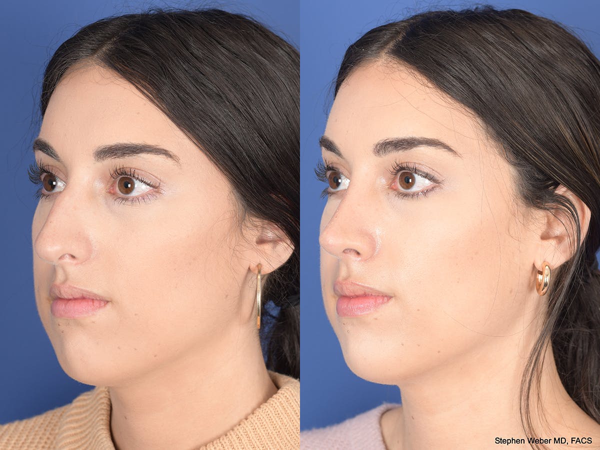 Rhinoplasty Before & After Gallery - Patient 961971 - Image 3